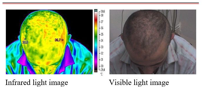 Image of blood irrigation by thermography 1
