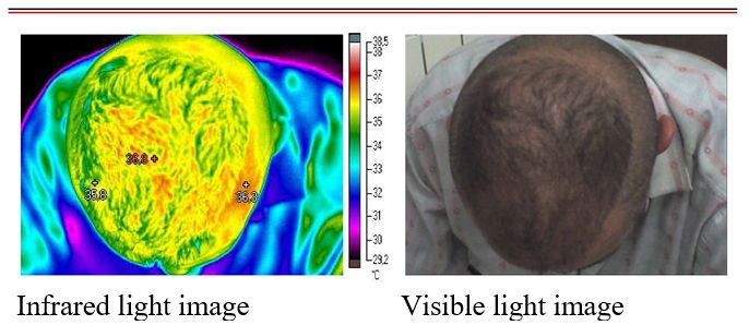 Image of blood irrigation by thermography 2