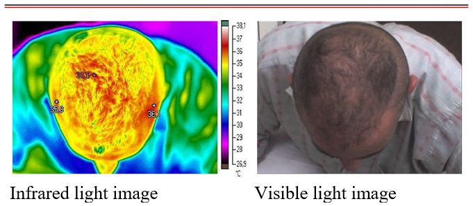Image of blood irrigation by thermography 3