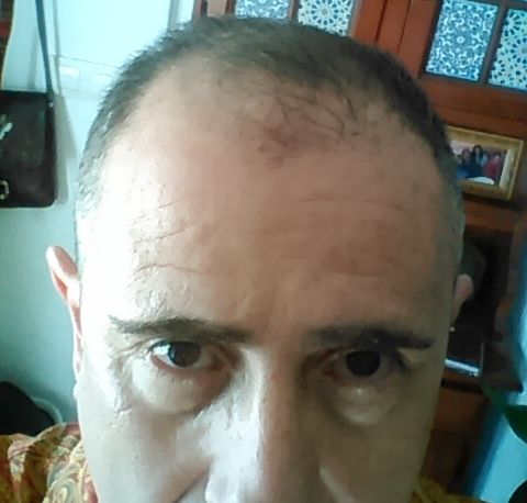 Hair at the start of double therapy