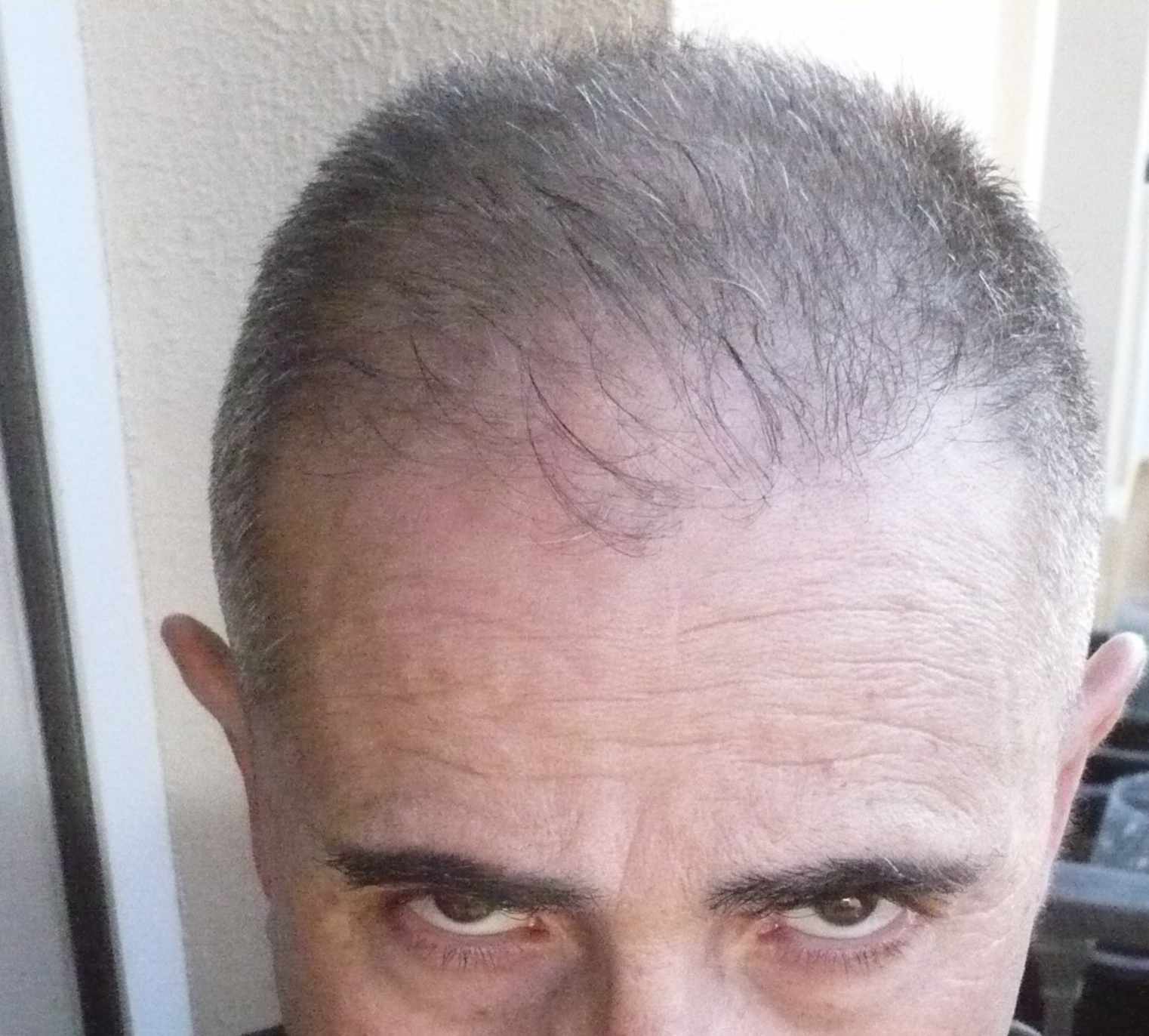 Recovered hair16